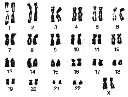 Origin of Down Syndrome Origin of Down Syndrome