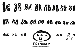 trisomy 21 karyotype